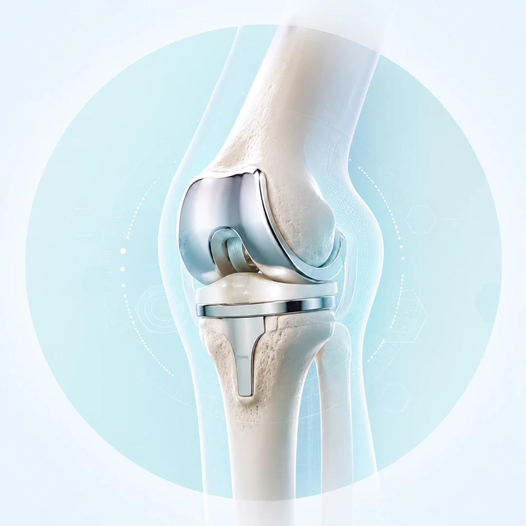 protesis de rodilla en 3d mexicali